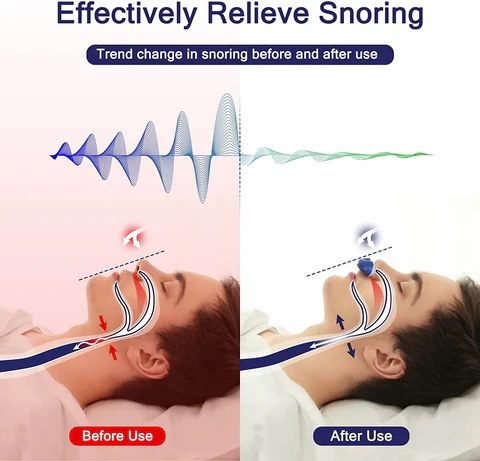 Clip nasale anti-russamento in silicone medicale, compatto e discreto, per migliorare il sonno riducendo il russare.