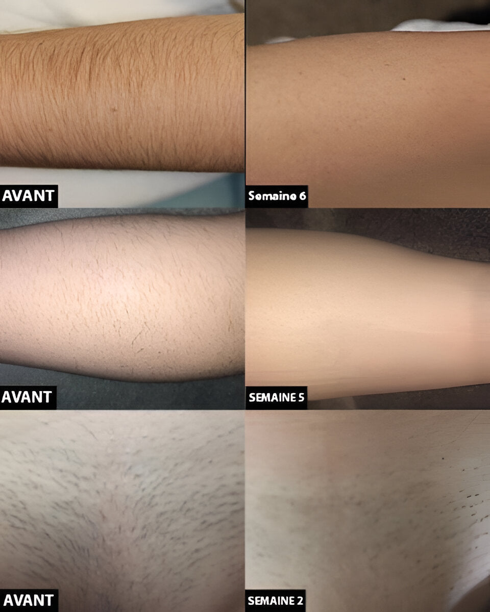 Women's personal care beauty device: At-Home Laser Hair Removal Handset for permanent, smooth results.
