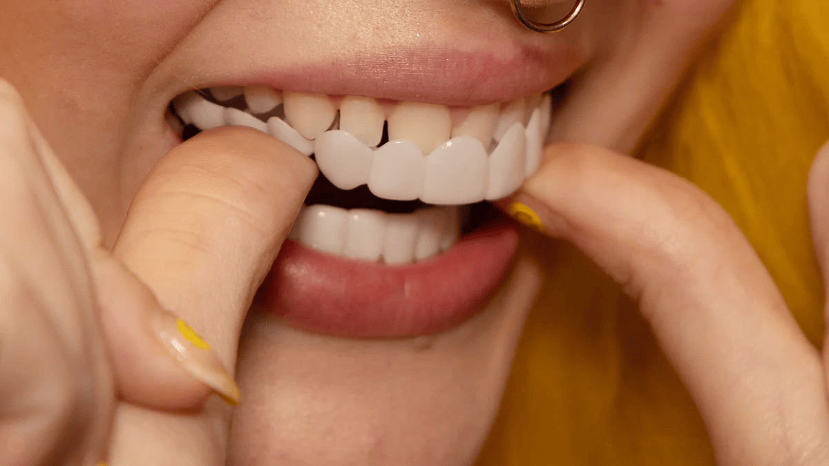 "Faccette dentali Snap-On bianche, migliorano sorriso; denti irregolari o scoloriti coperti per un effetto naturale e radioso