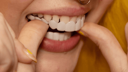 "Faccette dentali Snap-On bianche, migliorano sorriso; denti irregolari o scoloriti coperti per un effetto naturale e radioso