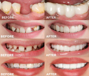Protesi dentale unisex EasyClick per sorriso naturale, discreta ed elegante. Pronta all'uso, effetto realistico immediato.